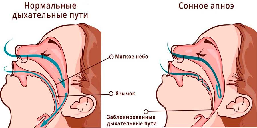 Схема дыхательных путей при нормальном сне и при апноэ