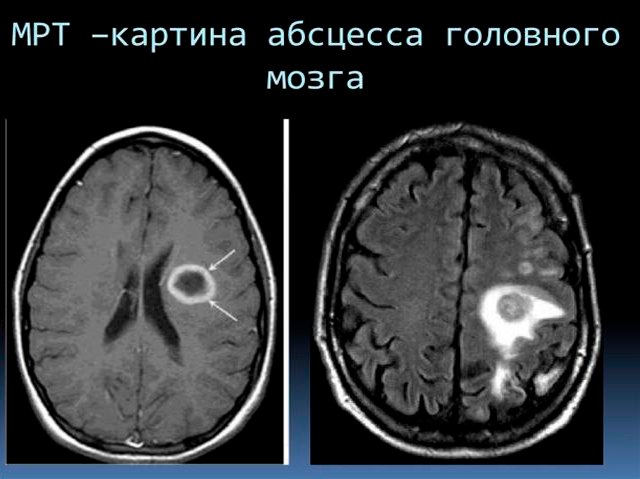 МРТ-снимок мозга с абсцессом