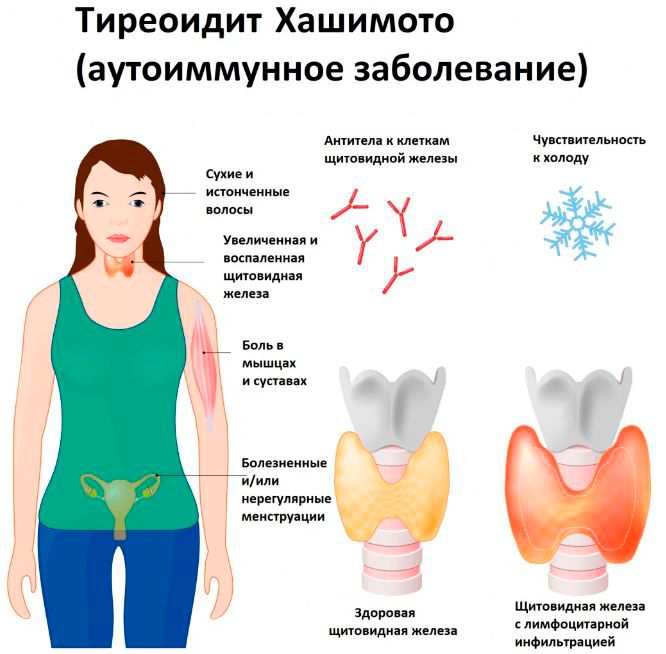 Энцефалопатия Хашимото