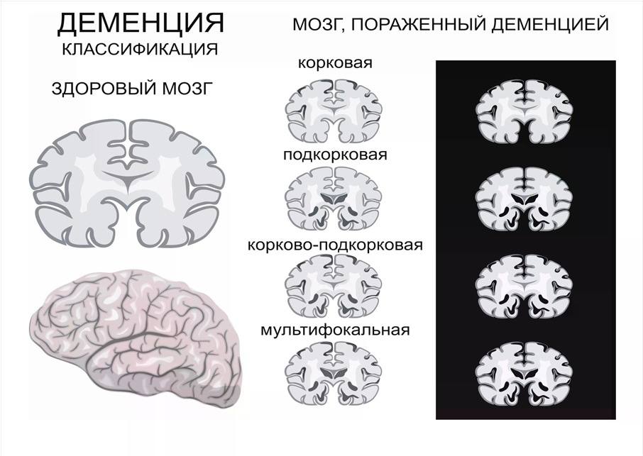 виды деменций