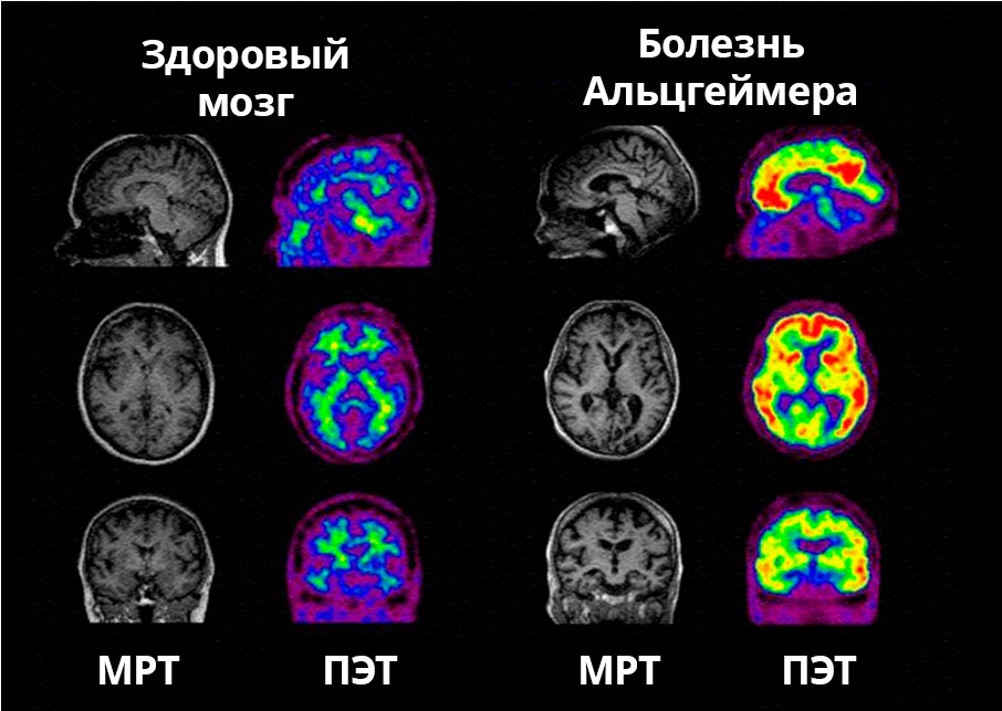 мрт головного мозга при деменции