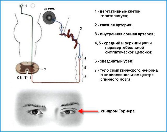 причины синдрома горнера