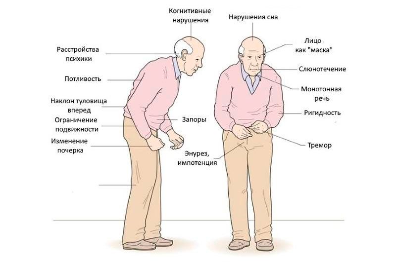 «Тремор покоя и брадикинезия — характерные признаки болезни Паркинсона»