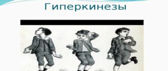 Гиперкинезы: виды, причины, симптомы и лечение непроизвольных движений