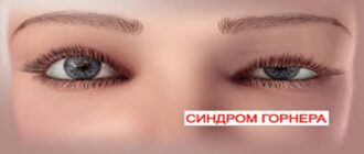 Синдром Горнера: причины, симптомы, диагностика и лечение