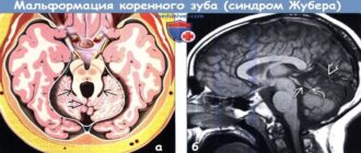 Новый генетический вариант синдрома Жубер открыт в России